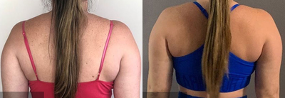 35-44 year old woman treated with Arm Lipo - Liposuction of the upper arms