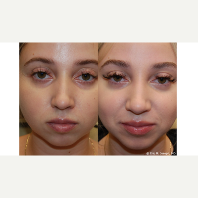 Permanent Non-Surgical Rhinoplasty and Chin Augmentation Before & After - Our lovely 21 year old patient is seen 6 months following two permanent non-surgical nose job treatments, and two permanent chin augmentation treatments with microdroplet Silikon-1000. You can see natural looking and permanent nasal profile bump camouflaging, and increased chin projection. This may be a welcome substitute for surgery for some people. Our patient received her third and final treatment after these photos were taken.