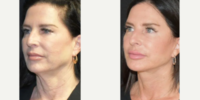 Woman treated with Facelift - This patient is 6 months post op facelift and fat transfer.