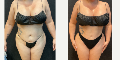 45-54 year old woman treated with Abdominal Etching, Brazilian Butt Lift - Patient had HD Liposuction and BBL