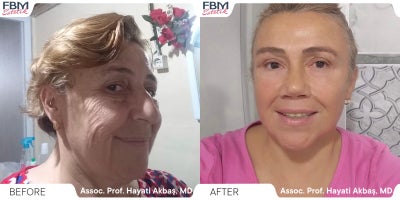 55-64 year old woman treated with Deep Plane Facelift, Neck Lift, Eyelid Surgery, Facial Fat Transfer, Rhinoplasty - 55-64 year old woman treated with Deep Plane Facelift, Neck Lift, Eyelid Surgery, Facial Fat Transfer, Rhinoplasty
