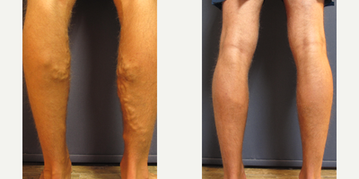 25-34 year old man treated with EVLT - Young male 6 months EVLT post-op