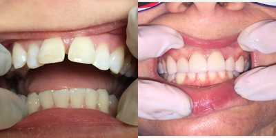 25-34 year old woman treated with Porcelain Veneers - Patient received only 6 porcelain veneers on the top.  This patient did not have any ortho work done (no braces before or after the procedure).  Her entire smile was done by Dr. Thompson in a single appointment.  This patient required one follow-up appointment 1 week later to check her bite and have the veneers permanently cemented.  Overall, Dr. Thompson made the shade of patient's teeth more naturally uniform; she also aligned her teeth to look naturally straight and closed the huge gap between her teeth.  The bottom teeth were not touched.