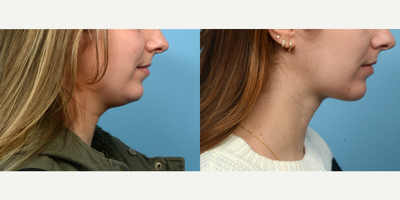 25-34 year old woman treated with Chin Surgery - Looking to define her jawline an improve the look of her double chin, this patient opted for submental liposuction with Dr. Wise. Two months post-op, she's thrilled with the outcome.