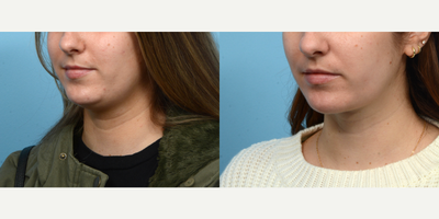 25-34 year old woman treated with Chin Surgery - Looking to define her jawline an improve the look of her double chin, this patient opted for submental liposuction with Dr. Wise. Two months post-op, she's thrilled with the outcome.