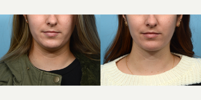 25-34 year old woman treated with Chin Surgery - Looking to define her jawline an improve the look of her double chin, this patient opted for submental liposuction with Dr. Wise. Two months post-op, she's thrilled with the outcome.