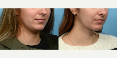 25-34 year old woman treated with Chin Surgery - Looking to define her jawline an improve the look of her double chin, this patient opted for submental liposuction with Dr. Wise. Two months post-op, she's thrilled with the outcome.