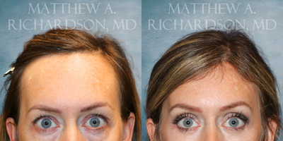 45-54 year old woman treated with Forehead Reduction - 45-54 year old woman treated with Forehead Reduction