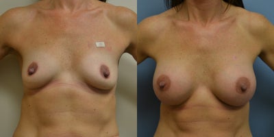 42 year old woman treated with Breast Augmentation - 42 year old woman treated with Breast Augmentation