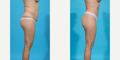 35-44 year old woman treated with Abdominal Etching, Diastasis Recti Repair, Drainless Tummy Tuck, Laser Liposuction, Liposculpt - Before and after Mommy Makeover breast augmentation. This patient wanted a breast augmentation as part of her mommy makeover. She had some volume loss, sagging, and asymmetry after multiple pregnancies. I did a dual plane breast augmentation to help the implants and breast tissue perfectly align. I used a silicone gel gummy bear SoftTouch implant sized 275cc moderate profile. She has the fullness and shape she wants and much better symmetry.