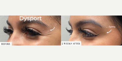 Woman treated with Dysport - Woman treated with Dysport