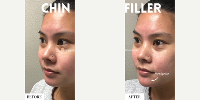 Woman treated with Restylane Lyft - We used Lyft and Defyne to help build a base and provide fine detailing/shape to the chinStats:1cc of Lyft1cc of Defyne