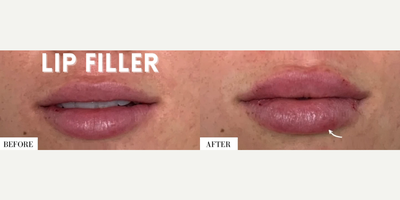 Woman treated with Lip Fillers - Woman treated with Lip Fillers