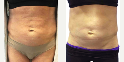 25-34 year old woman treated with Thermage FLX - This patient received one Thermage FLX treatment to tone and lift abdominal skin. Results are 3-months post-treatment.
