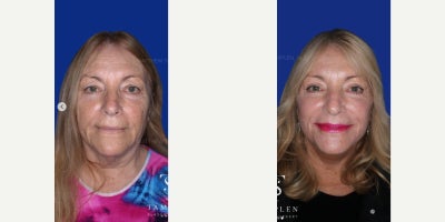 55-64 year old woman treated with Facelift, Neck Lift, Brow Lift, Eyelid Surgery, CO2 Laser - 55-64 year old woman treated with Facelift, Neck Lift, Brow Lift, Eyelid Surgery, CO2 Laser