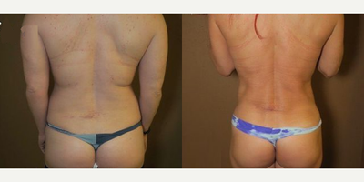 Woman treated with Liposuction - Woman treated with Liposuction