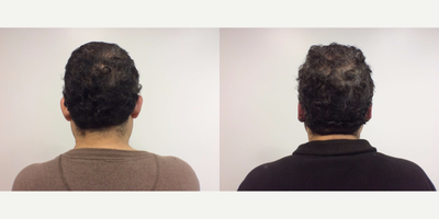 55-64 year old man treated with Ear Surgery - This gentleman had very prominent ears. He wanted them to be less noticeable and closer to his head. We performed an otoplasty which pinns the ears closer to the scalp.&nbsp;