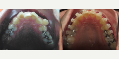 25-34 year old man treated with Damon Braces - Damon Braces Treatment