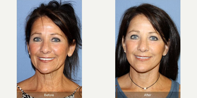 50-59 year old woman treated with Lower Facelift - During her procedures, Dr. Sadati tightened the muscles in her neck, which eliminated the harsh appearance of her neck bands. He corrected the vertical and diagonal lines on her cheeks and made the skin along her jawline tauter during her facelift, which included reinforcing the muscles and tendons below the skin.
