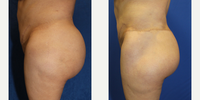 45-54 year old woman treated with Silicone Injection Removal - Meet a 45-year-old Hispanic female patient who, standing at 5'2 and weighing 190 pounds, had raw silicone injected into her buttocks in 1998, which ultimately led to discomfort and pain. In 2022, she underwent an incredible silicone injection removal procedure with skilled Dr. J. Timothy Katzen in Beverly Hills, California. During surgery, Dr. Katzen successfully removed 9 pounds of silicone from her buttocks, which left her feeling much better and extremely satisfied with her results!