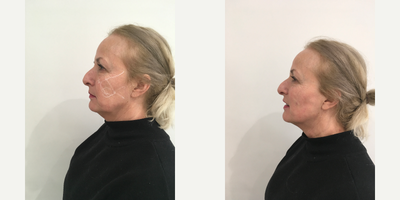 55-64 year old woman treated with Ellanse - Patient initially requested a Silhouette Soft Lift, however shs had lateral volume loss and heavy tissues so we proceeded with an Ellanse Treatment. We injected 3 mls of Ellanse into lateral cheek to lift the jawline.