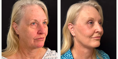 Woman treated with Eyelid Surgery - Woman treated with Deep Plane Facelift, Eyelid Surgery through upper blepharoplasty and lower blepharoplasty, Facial Fat Transfer, and Lateral Brow Lift.