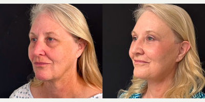 Woman treated with Eyelid Surgery - Woman treated with Deep Plane Facelift, Eyelid Surgery through upper blepharoplasty and lower blepharoplasty, Facial Fat Transfer, and Lateral Brow Lift.