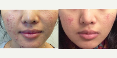 18-24 year old woman treated with Accutane - Female patient before and after 5 months of Accutane. Significant reduction in inflammatory acne lesions and pore congestion.