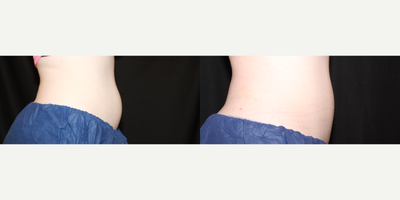 25-34 year old woman treated with CoolSculpting, CoolSculpting Elite - 25-34 year old woman treated with CoolSculpting, CoolSculpting Elite two treatments to the lower abdomen