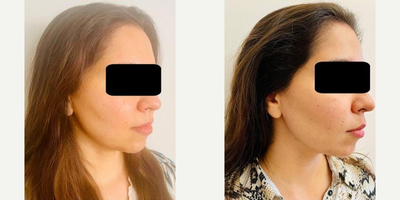 Woman treated with Profhilo - Woman treated with Nonsurgical Neck Lift with PROFHILO - 2 treatments (2ml total)