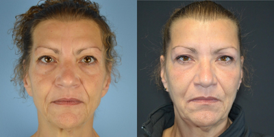 55-64 year old woman treated with ArteFill - 55 year old female received ArteFill to cheeks, temples, nasolabial folds and marionette lines
