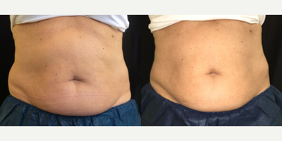 Woman treated with CoolSculpting - Woman treated with CoolSculpting