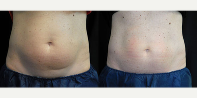 Woman treated with CoolSculpting - Woman treated with CoolSculpting (2 small applicators on abdomen and 2 small on love handles)