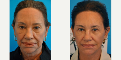 Woman treated with Neck Lift - Woman treated with Neck Lift