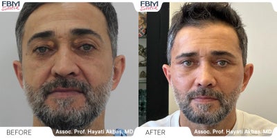 35-44 year old man treated with Facelift, Eyelid Surgery, Facial Fat Transfer - 35-44 year old man treated with Facelift, Eyelid Surgery, Facial Fat Transfer