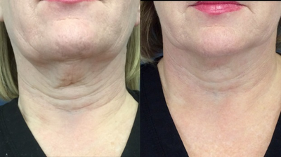 55-64 year old woman treated with Fractional Laser - 62 Year Old Female pre and post 4 Fractional Laser Treatments. Excellent skin tightening, wrinkle reduction results.