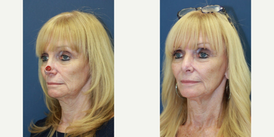 Mohs Surgery Reconstruction - Nasal Reconstruction after Mohs Surgery