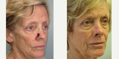 Mohs Surgery Reconstruction - Mohs Surgery Reconstruction