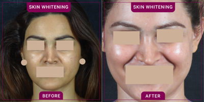 25-34 year old woman treated with Skin Lightening - Glowing Skin Procedure: Glutathione Injection Best for: skin lightening, glowing, blemish-free skin  Method: slow IV injections done weekly  Duration of procedure: 1-2 hours Downtime: none Pain: no pain Results: Takes a couple of weeks to start showing