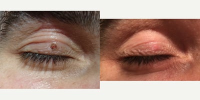 35-44 year old man treated with Cyst Removal from upper eyelid - 35-44 year old man treated with Cyst Removal by Plasma coagulation from upper eyelid