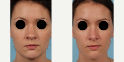 Woman treated with Revision Rhinoplasty - Woman treated with Revision Rhinoplasty