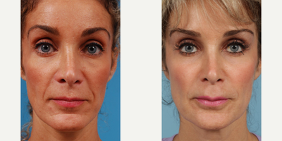 Woman treated with Revision Rhinoplasty - Woman treated with Revision Rhinoplasty