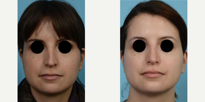 Woman treated with Revision Rhinoplasty - Woman treated with Revision Rhinoplasty