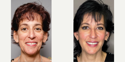 Woman treated with Nonsurgical Facelift - Woman treated with Nonsurgical Facelift