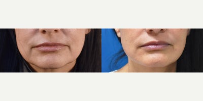 Jaw shaping with Restylane Lyft before and after Los Angeles - This 40 something patient wanted to improve her jawline.  Indentations at either side of the chin are made worse as the cheek fat pads descend, forming the dreaded jowls.  A little Restylane Lyft does a nice job of camouflaging the jowls and returns a more youthful jaw contour for our patient.
