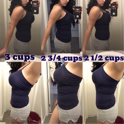 Dr Kevin Ho - Natural D cup breasts after babies. This lady went from an A  to a D cup using 375 cc moderate plus profile implants. Check out Dr Ho's  results