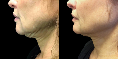 52 year old woman treated with Thermage FLX - Patient received one Thermage FLX to the full face and jowls for improve skin tightness and enhance collagen production over time.