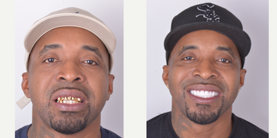 35-44 year old man treated with Smile Makeover, Lumineers - This patient make the best decision removing this gold crowns and get Porcelain; looks more clean and healthy.Enjoy your new Smile!!!