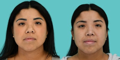 18-24 year old woman treated with Asian Rhinoplasty, Rhinoplasty - This 24-year-old Asian female patient is shown 6 months after primary rhinoplasty. She presented with thick nasal skin, congenital nasal abnormalities, significant nasal and tip asymmetry, a bossae tip, short nose, and overrotated nasal tip.Dr. Jacob Sedgh performed a customized Asian rhinoplasty using the patients own rib cartilage to reconstruct and strengthen the nasal framework while addressing the asymmetric tip, bulbous nasal tip, short and over rotated nose, and overall nasal imbalance. The goal was to create improved symmetry, tip definition, structural stability, and facial harmony while maintaining a natural appearance that complements the patients individual features.At only 6 months post-op, the nose is continuing to heal and refine, particularly given the patients thick skin. Her rhinoplasty results demonstrate significant improvement in nasal symmetry, tip position, contour, and overall balance, with further refinement expected as swelling continues to resolve.