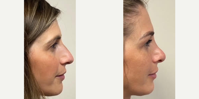 25-34 year old woman treated with Rhinoplasty - 6 months after a rhinoplasty